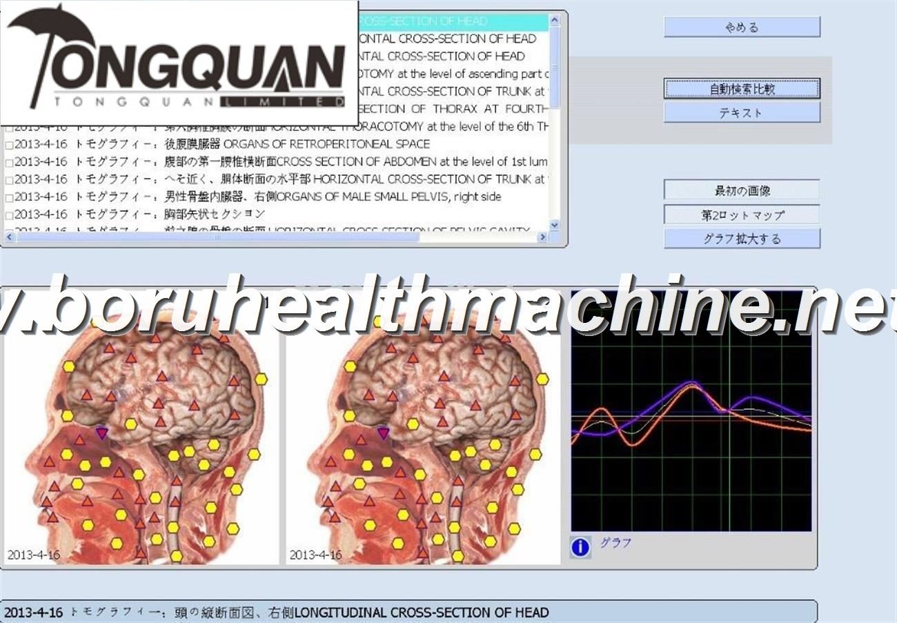 5DNLS capsule health test machine Russia vision quantum health test machine